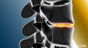 Georgetown degenerative spinal changes 