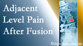 Dr. Butwell offers relieving care non-surgically to back pain patients suffering with adjacent level pain after spinal fusion surgery.